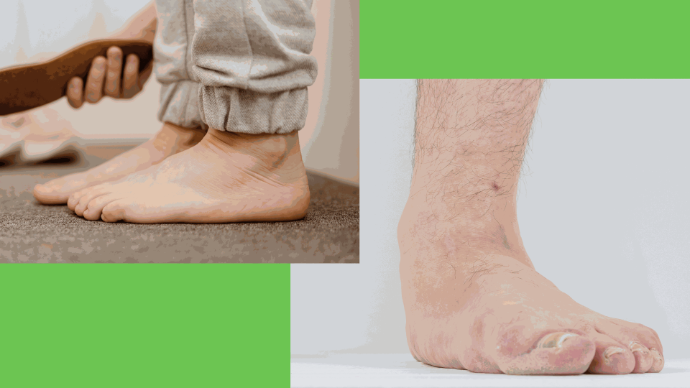 flat foot