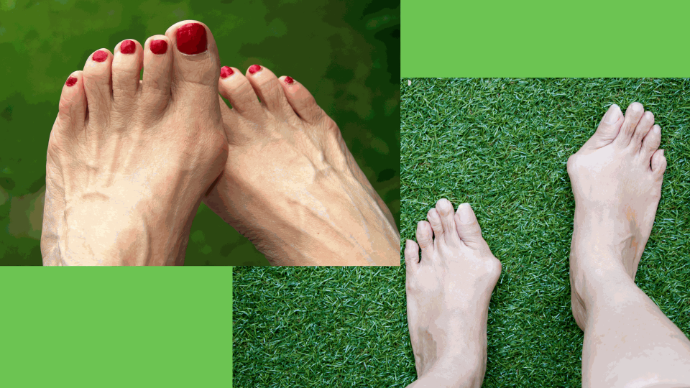 bunion foot